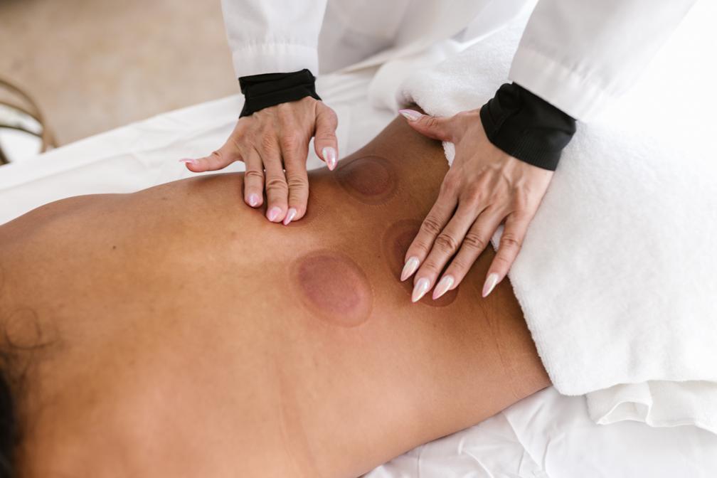 Health benefits of cupping therapy